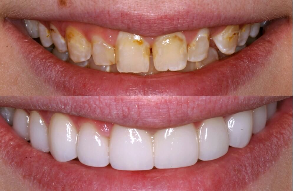 Cosmetic dentistry