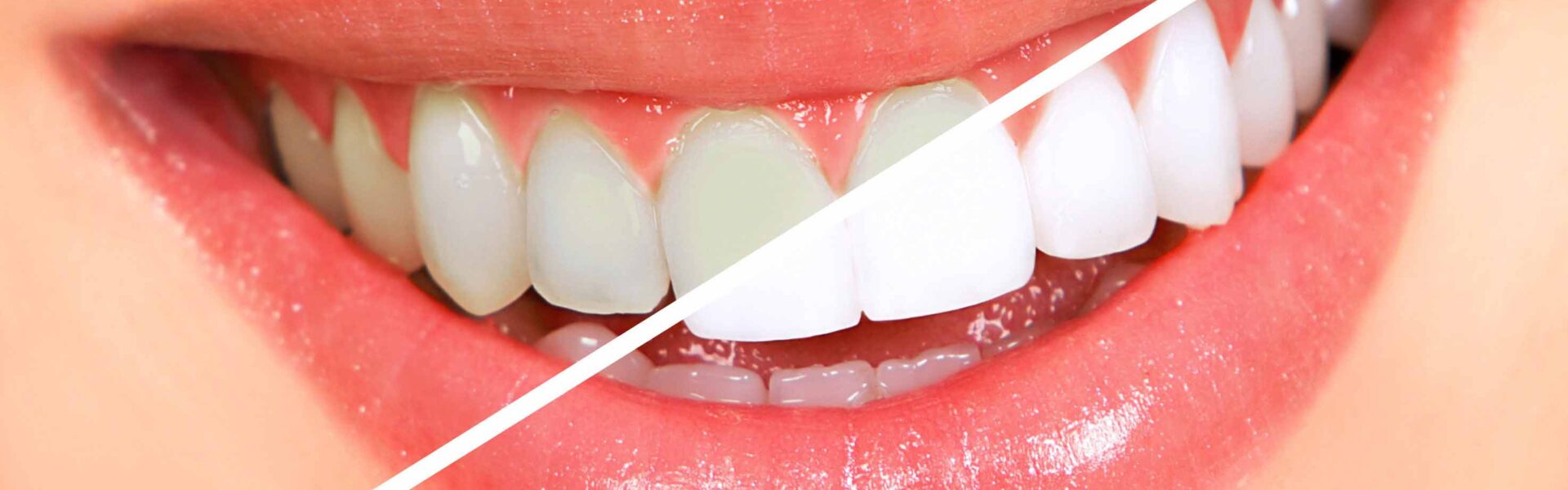teeth-whitening
