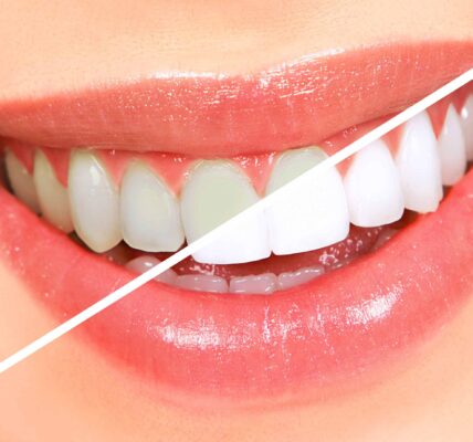 teeth-whitening