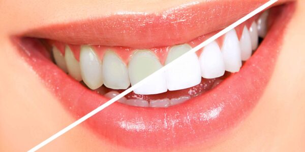 teeth-whitening